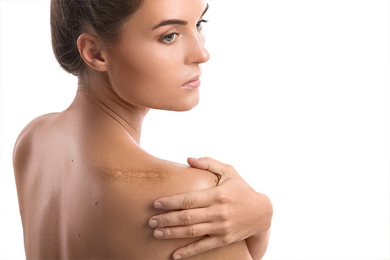 Narbenbehandlung – Narben entfernen lassen kosmetisch