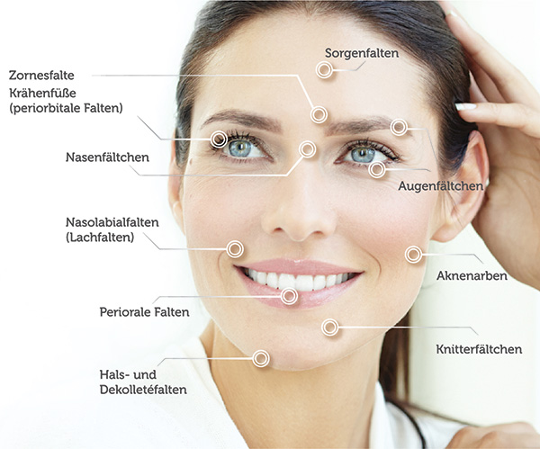 Tixel Behandlung Anwendungsmöglichkeiten Gesicht und Hals - von Zornesfalte über Sorgenfalten bis Nasobialfalten oder Augenfältchen