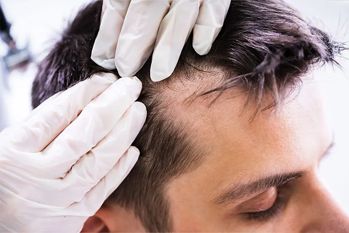 PCP-Behandlung Haare PCP-Behandlung Haare – Mann bei Eigenblutbehandlung der Kopfhaut für ein verbessertes Haarwachstum
